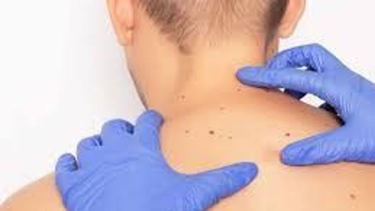 Güneşten Korun, Hayatını Koru: Cilt Kanseri Riskine Karşı 5 Önemli Tavsiye