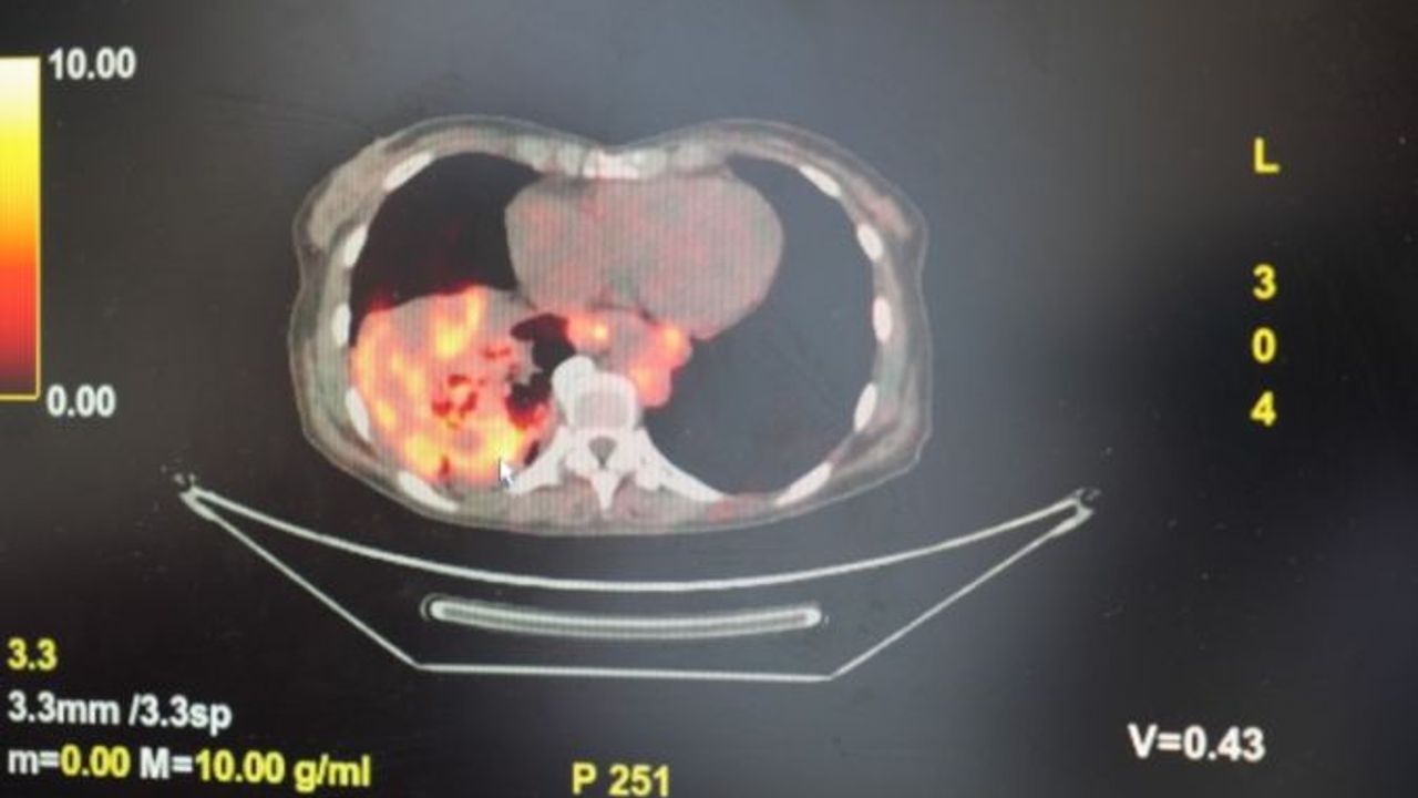 Akciğer Kanseri Artık Sadece Sigara İçenleri Vurmuyor! Dikkat Çeken Araştırma