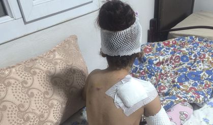 Şanlıurfa’da başıboş köpek küçük çocuğu yaraladı: 150 dikiş atıldı!