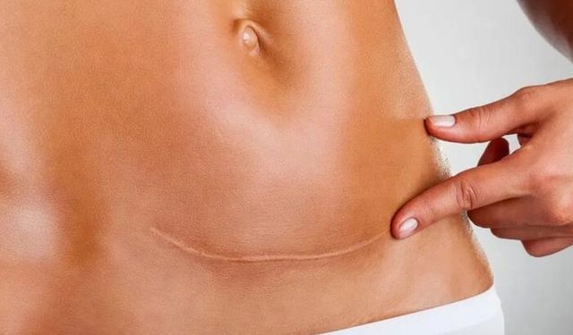 Sezaryen Sonrası İstmosel Nedir ve Nasıl Önlenir?