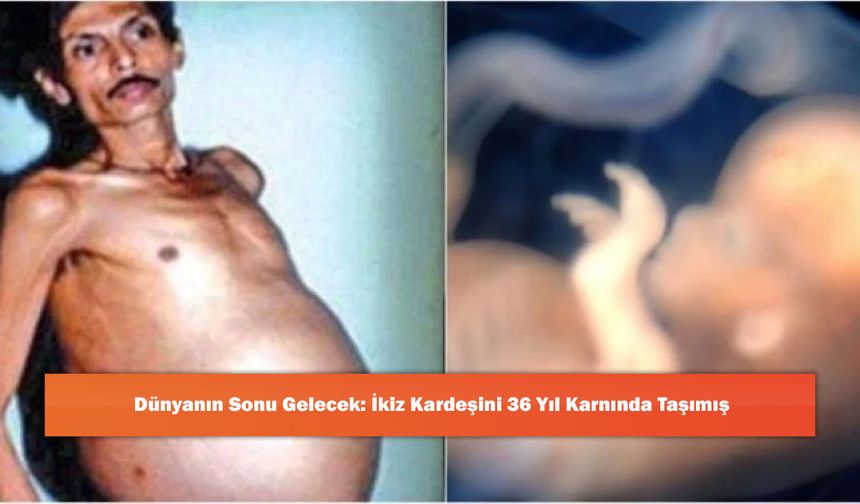 Dünyanın Sonu Gelecek: İkiz Kardeşini 36 Yıl Karnında Taşımış