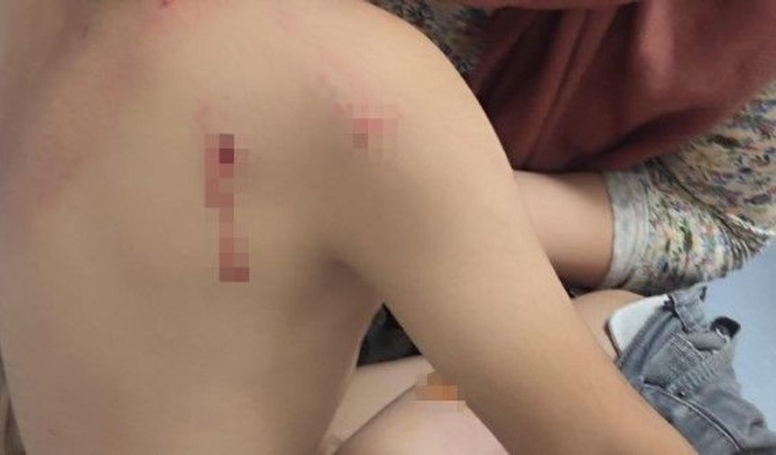 Şanlıurfa’da Korkutan Olay: Köpeklerin Saldırdığı Çocuğun Başına 15 Dikiş Atıldı