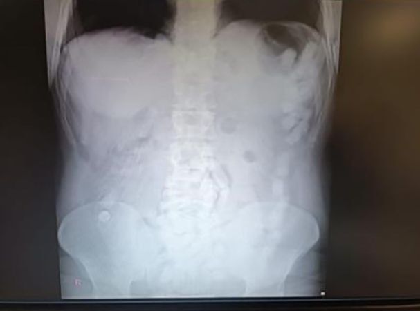 Türkiye’ye Yutularak Getirilen Uyuşturucuya Rekor Ceza! (2)