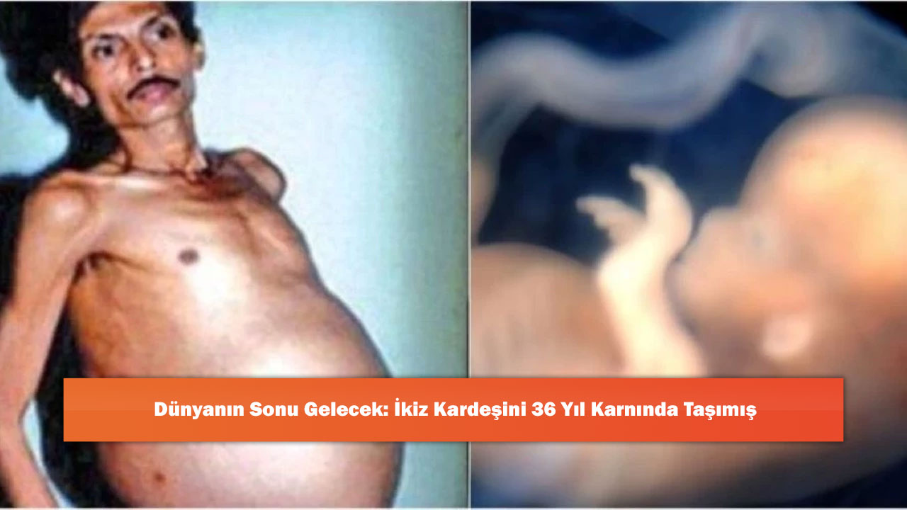 Dünyanın Sonu Gelecek: İkiz Kardeşini 36 Yıl Karnında Taşımış